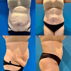 Abdominoplastie - Dr Julien Luini