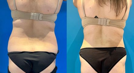 Liposuccion des hanches - Dr Julien Luini