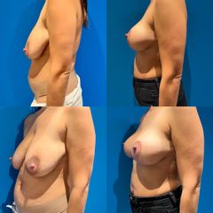 Lifting mammaire - Dr Julien Luini