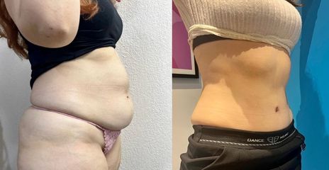 Abdominoplastie - Dr Julien Luini