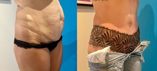 Liposuccion - Dr Julien Luini
