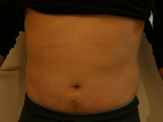 CRYOLIPOLYSE AVANT TRAITEMENT FACE