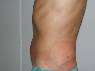 CRYOLIPOLYSE APRES TRAITEMENT profil