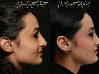 Rhinoplastie avant et après - 875915