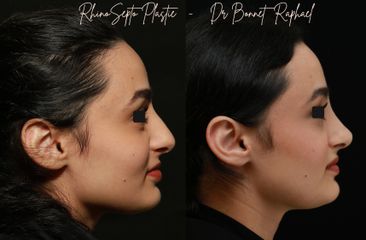rhino profil avant apres