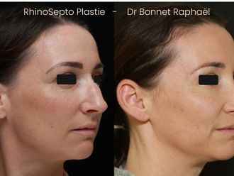 Rhinoplastie avant et après - 875916