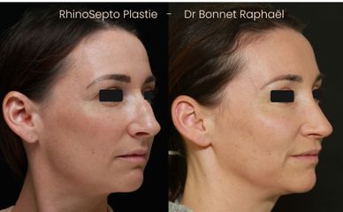 Rhinoplastie