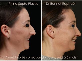Rhinoplastie avant et après - 875917