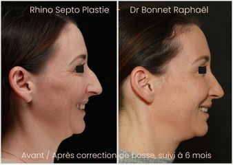 Rhinoplastie avant après