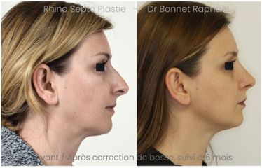 Rhinoplastie bosse avant après 6 mois