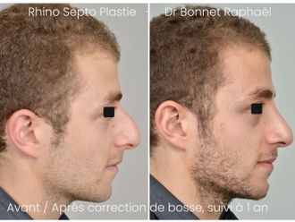 Rhinoplastie avant et après - 875919