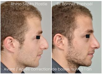 Rhinoplastie bosse avant après