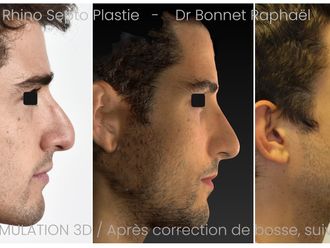 Rhinoplastie avant et après - 875920