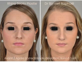 Rhinoplastie avant et après - 875921