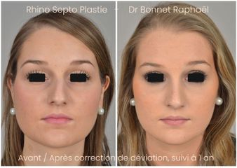 Rhinoplastie déviation avant après