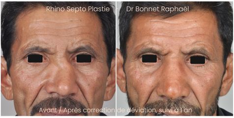 Rhinoplastie déviation avant après 1 an