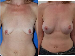 Avant après Lifting mammaire avec implants mammaires