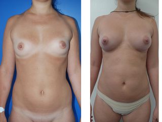 Avant après Lipofilling mammaire
