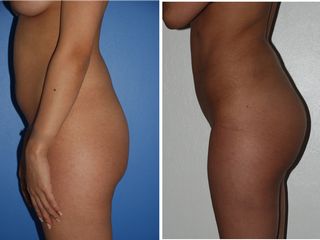 Avant après Lipofilling des fesses