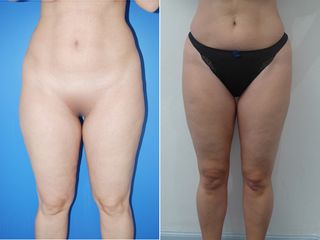 Avant après Liposuccion face interne des cuisses