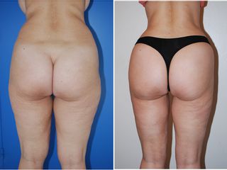 Avant après liposuccion des hanches