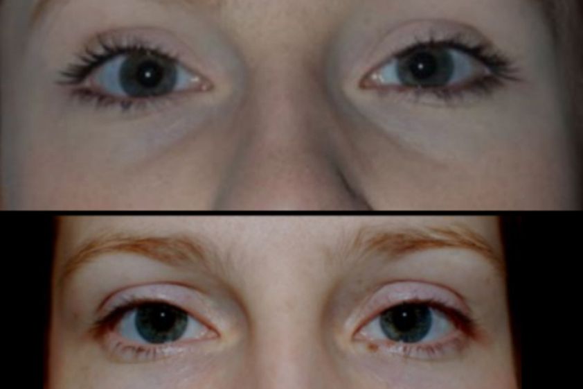 Lipofilling avant et après - 573679