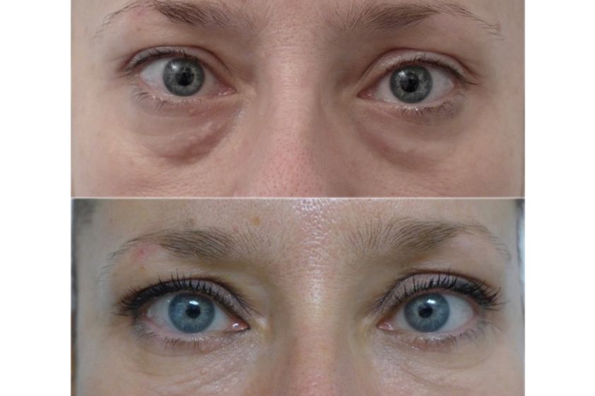 Lipofilling avant et après - 660719