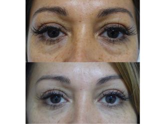 Blépharoplastie - 660720