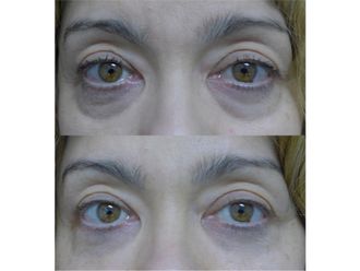 Lipofilling - 660725