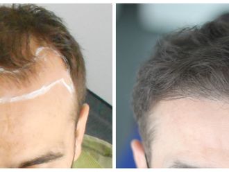 Greffe de cheveux - 794339