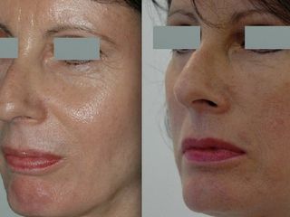 Avant après Lifting Medio facial ou vertical antérieur  (ou concentrique malar lift)