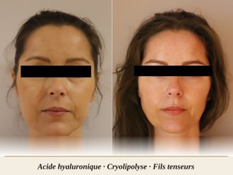 Acide Hyaluronique avant et après - 880457