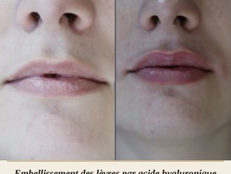 Acide Hyaluronique avant et après - 880569