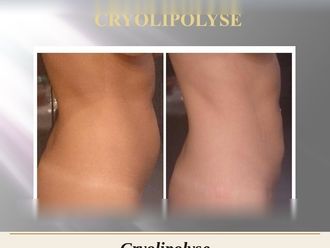 Cryolipolyse avant et après - 880572