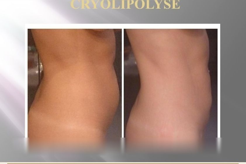 Cryolipolyse avant et après - 880572