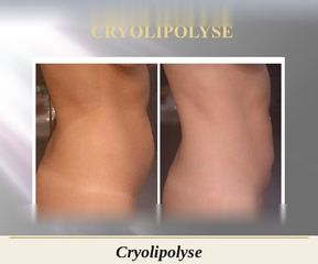 OS_cryolipolyse