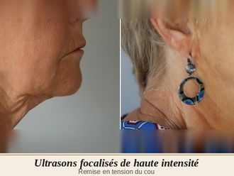 HIFU avant et après - 880573