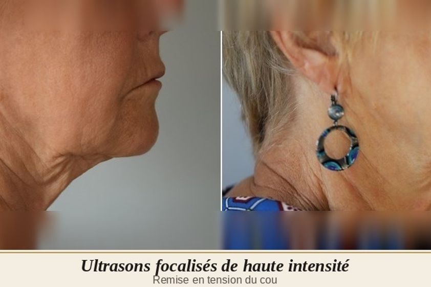 HIFU avant et après - 880573