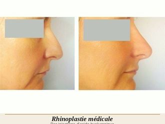 Rhinoplastie médicale avant et après - 880574