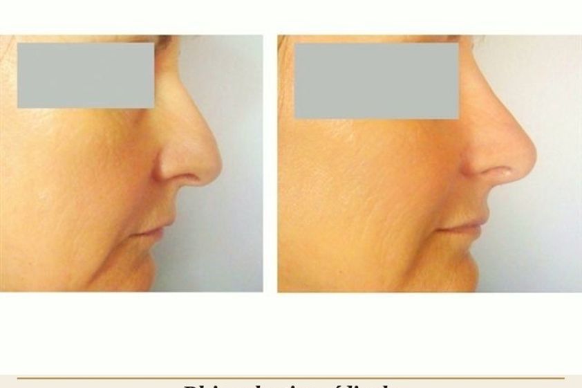 Rhinoplastie médicale avant et après - 880574