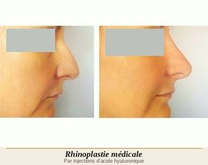 rhinoplastie medicale - O2rigine Studio