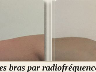 Radiofréquence avant et après - 880575