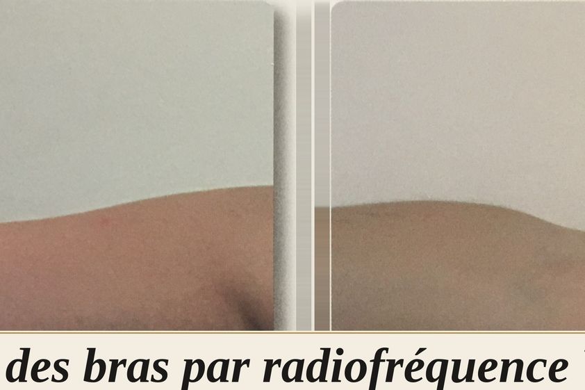 Radiofréquence avant et après - 880575