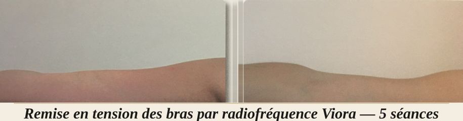 bras radiofrequence - O2rigine Studio