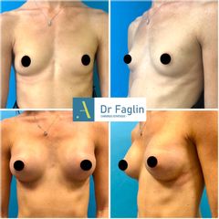 Augmentation mammaire - Dr Pierre Faglin