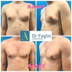 Gynécomastie - Dr Pierre Faglin
