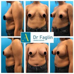 Mastopexie - Dr Pierre Faglin