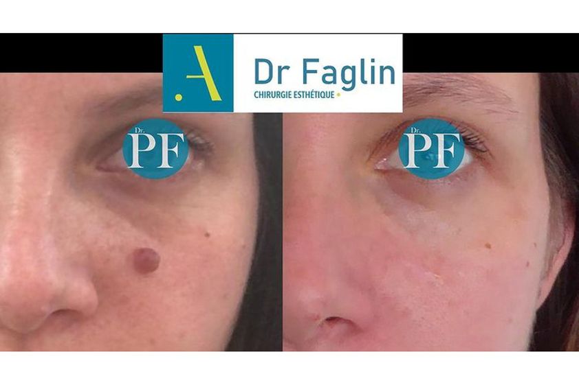 Grains de beauté avant et après - 809667