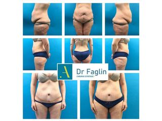 Abdominoplastie - Dr Pierre Faglin