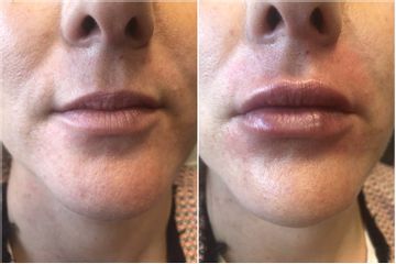 Augmentation des lèvres - Dr Malika Azzam